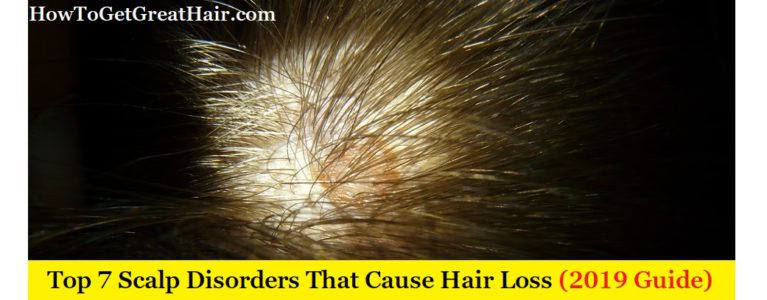 Top 7 Scalp Disorders That Cause Hair Loss (2019 Guide)