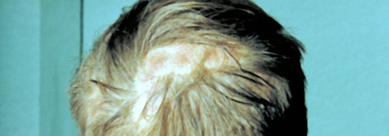 Top 7 Scalp Disorders That Cause Hair Loss (2019 Guide)